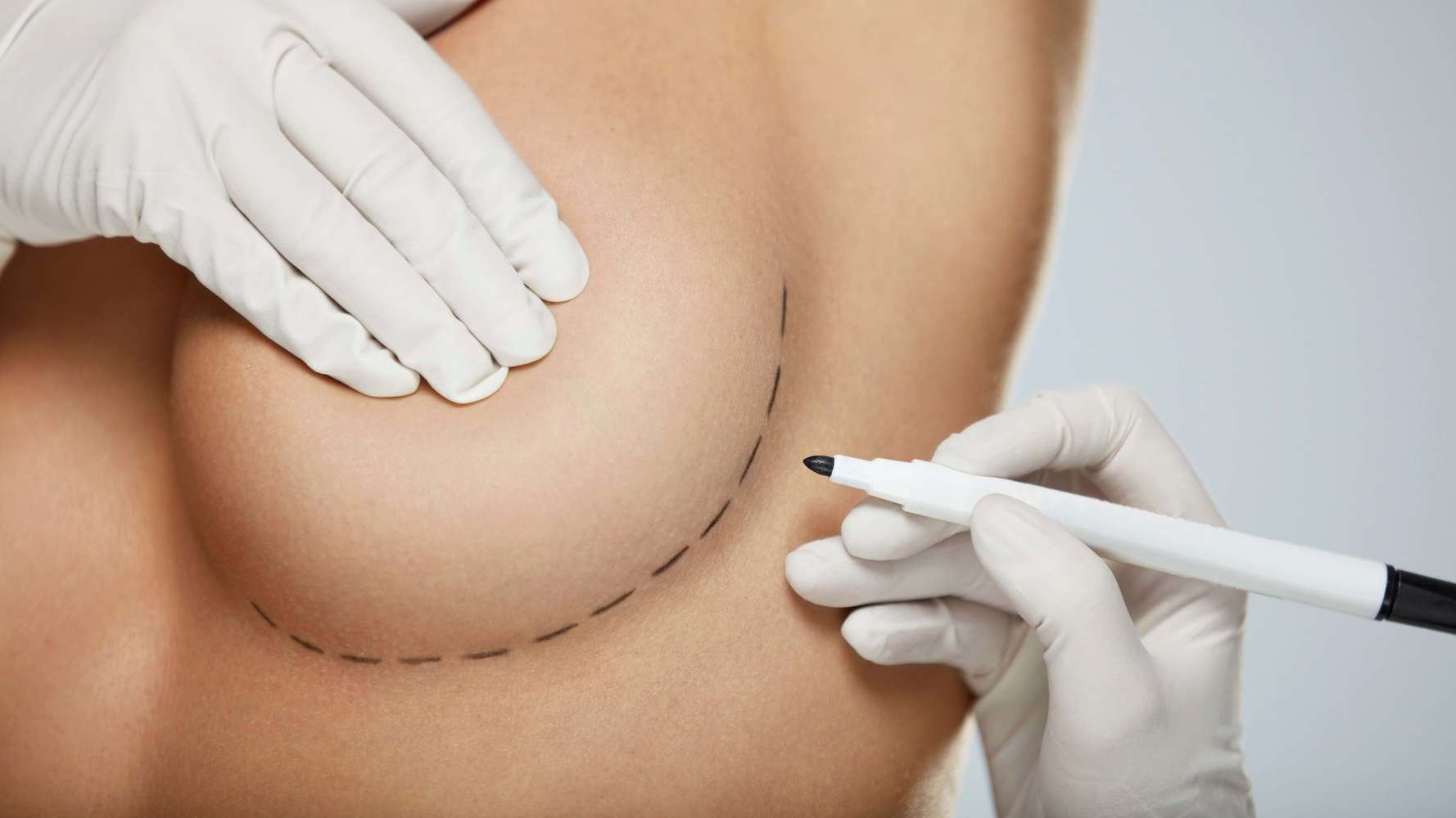 Die Brustvergrößerung ist einer der am häufigsten durchgeführte Eingriff der Plastischen Chirurgie.